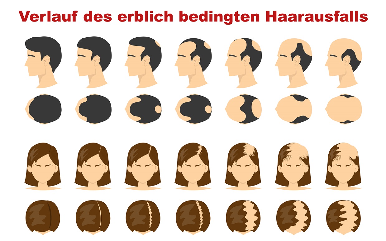 Verlauf Haarausfall